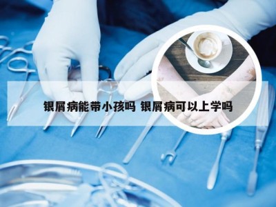 银屑病能带小孩吗 银屑病可以上学吗