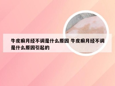 牛皮癣月经不调是什么原因 牛皮癣月经不调是什么原因引起的