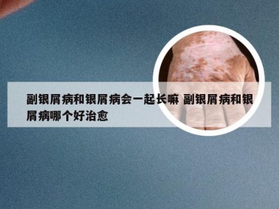 副银屑病和银屑病会一起长嘛 副银屑病和银屑病哪个好治愈