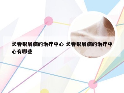 长春银屑病的治疗中心 长春银屑病的治疗中心有哪些