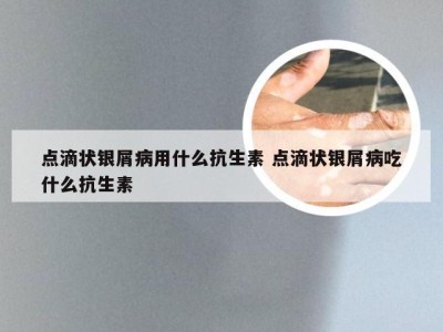 点滴状银屑病用什么抗生素 点滴状银屑病吃什么抗生素