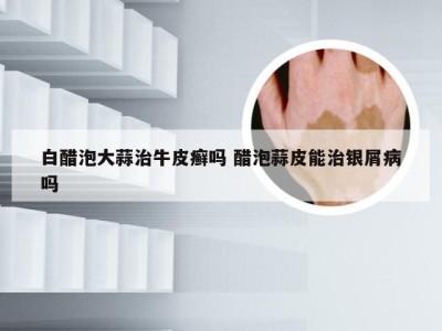 白醋泡大蒜治牛皮癣吗 醋泡蒜皮能治银屑病吗