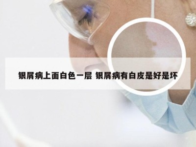 银屑病上面白色一层 银屑病有白皮是好是坏