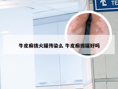 牛皮癣拔火罐传染么 牛皮癣拔罐好吗