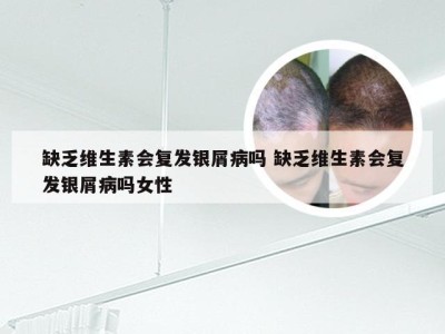 缺乏维生素会复发银屑病吗 缺乏维生素会复发银屑病吗女性