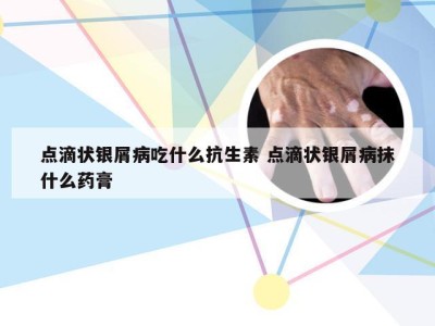 点滴状银屑病吃什么抗生素 点滴状银屑病抹什么药膏