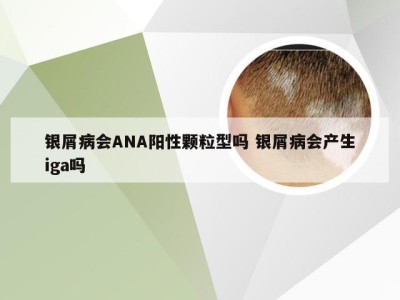 银屑病会ANA阳性颗粒型吗 银屑病会产生iga吗