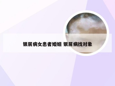 银屑病女患者婚姻 银屑病找对象