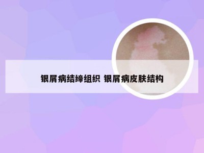 银屑病结缔组织 银屑病皮肤结构