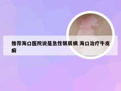 推荐海口医院说是急性银屑病 海口治疗牛皮癣