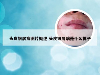头皮银屑病图片概述 头皮银屑病是什么样子