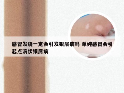 感冒发烧一定会引发银屑病吗 单纯感冒会引起点滴状银屑病
