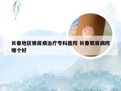 长春地区银屑病治疗专科医院 长春银屑病院哪个好