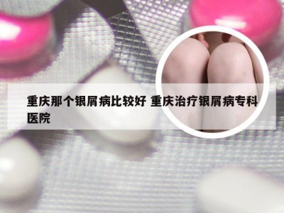 重庆那个银屑病比较好 重庆治疗银屑病专科医院