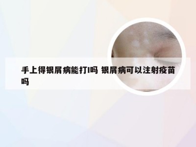 手上得银屑病能打I吗 银屑病可以注射疫苗吗