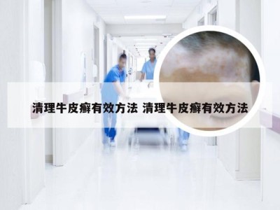 清理牛皮癣有效方法 清理牛皮癣有效方法