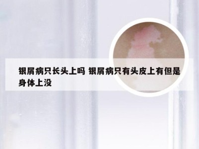 银屑病只长头上吗 银屑病只有头皮上有但是身体上没