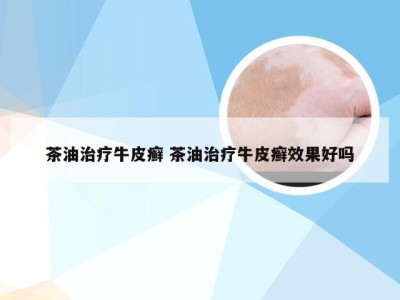 茶油治疗牛皮癣 茶油治疗牛皮癣效果好吗