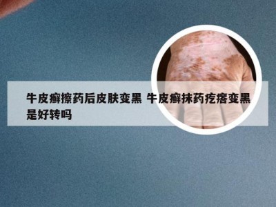 牛皮癣擦药后皮肤变黑 牛皮癣抹药疙瘩变黑是好转吗
