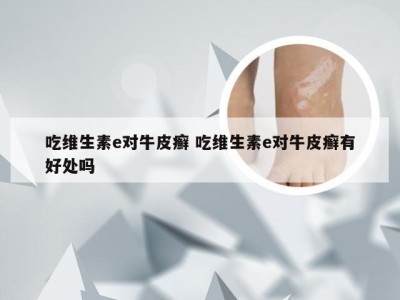 吃维生素e对牛皮癣 吃维生素e对牛皮癣有好处吗