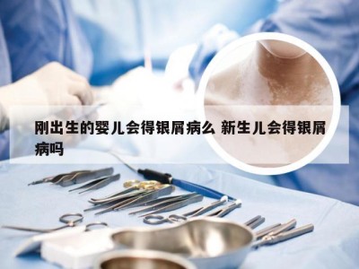 刚出生的婴儿会得银屑病么 新生儿会得银屑病吗