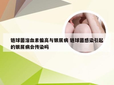 链球菌溶血素偏高与银屑病 链球菌感染引起的银屑病会传染吗