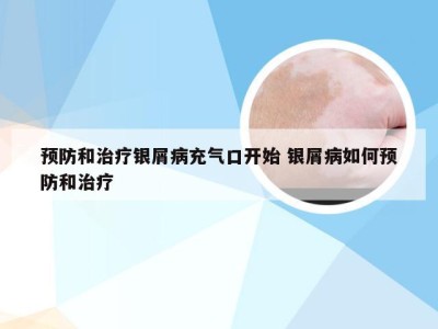 预防和治疗银屑病充气口开始 银屑病如何预防和治疗