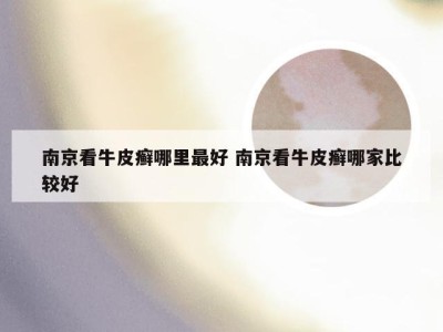 南京看牛皮癣哪里最好 南京看牛皮癣哪家比较好