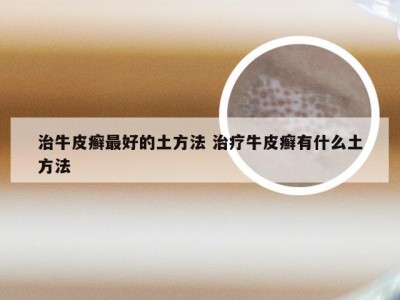 治牛皮癣最好的土方法 治疗牛皮癣有什么土方法