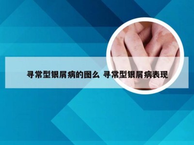 寻常型银屑病的图么 寻常型银屑病表现