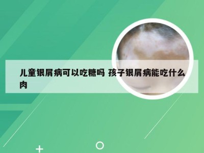 儿童银屑病可以吃糖吗 孩子银屑病能吃什么肉