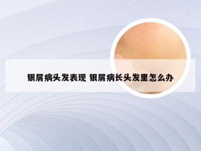 银屑病头发表现 银屑病长头发里怎么办