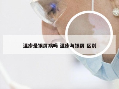 湿疹是银屑病吗 湿疹与银屑 区别