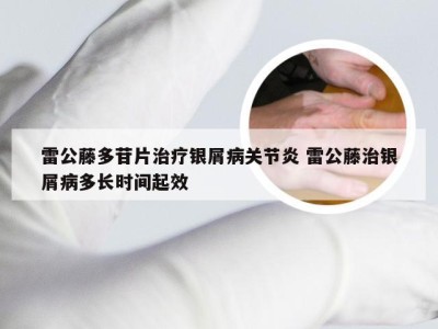 雷公藤多苷片治疗银屑病关节炎 雷公藤治银屑病多长时间起效
