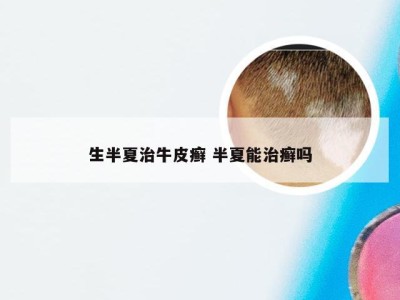 生半夏治牛皮癣 半夏能治癣吗
