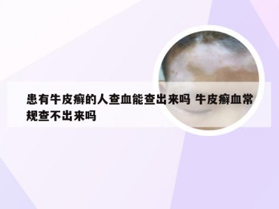 患有牛皮癣的人查血能查出来吗 牛皮癣血常规查不出来吗