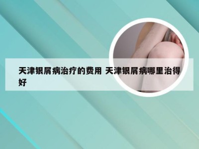 天津银屑病治疗的费用 天津银屑病哪里治得好