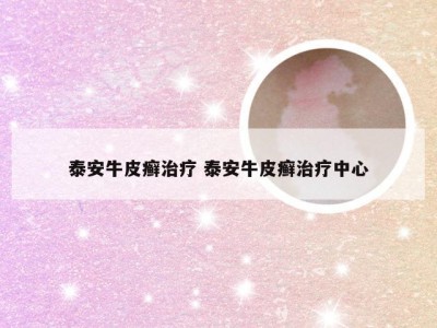 泰安牛皮癣治疗 泰安牛皮癣治疗中心