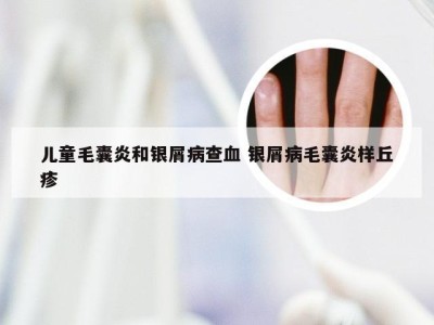 儿童毛囊炎和银屑病查血 银屑病毛囊炎样丘疹