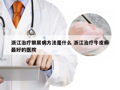 浙江治疗银屑病方法是什么 浙江治疗牛皮癣最好的医院