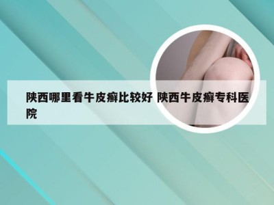 陕西哪里看牛皮癣比较好 陕西牛皮癣专科医院