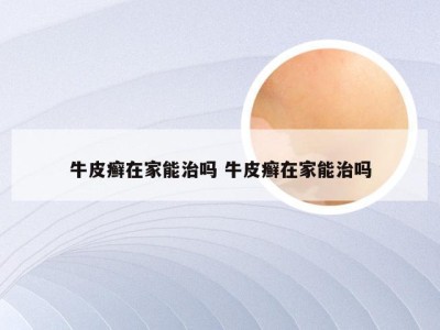 牛皮癣在家能治吗 牛皮癣在家能治吗