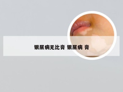 银屑病无比膏 银屑病 膏