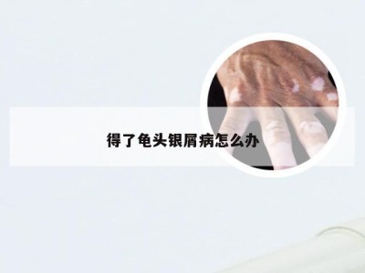 得了龟头银屑病怎么办
