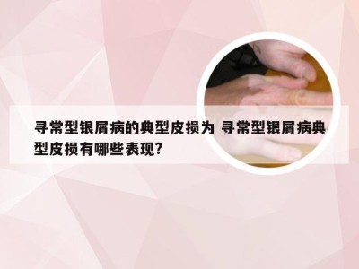 寻常型银屑病的典型皮损为 寻常型银屑病典型皮损有哪些表现?