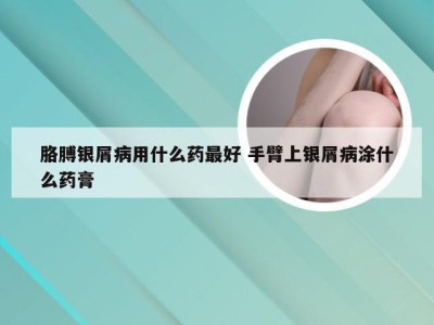 胳膊银屑病用什么药最好 手臂上银屑病涂什么药膏