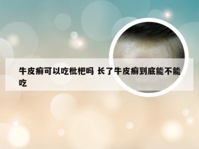牛皮癣可以吃枇杷吗 长了牛皮癣到底能不能吃