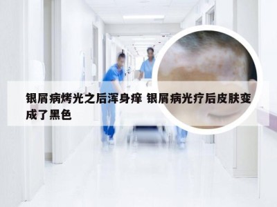 银屑病烤光之后浑身痒 银屑病光疗后皮肤变成了黑色
