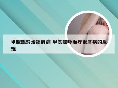甲胺蝶蛉治银屑病 甲氨蝶呤治疗银屑病的原理