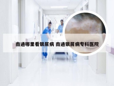南通哪里看银屑病 南通银屑病专科医院